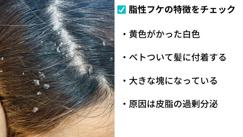 脂性フケの特徴