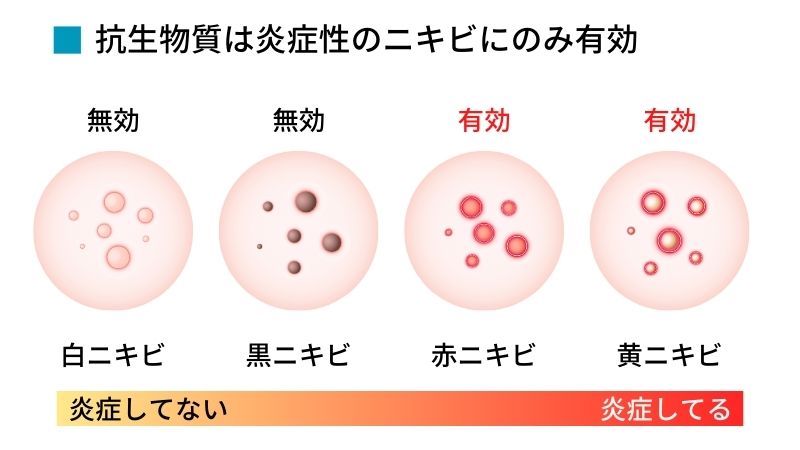 抗生物質は炎症性のニキビにのみ有効
