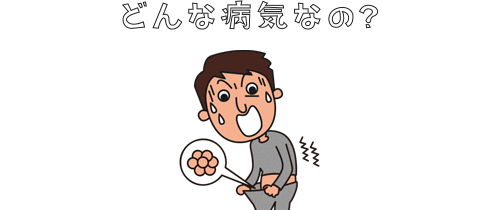 尖圭コンジローマとは?