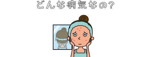 尋常性ざ瘡(ニキビ)とは?