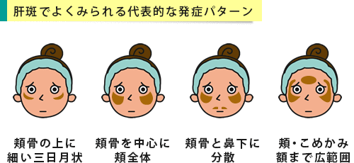 肝斑によくある発症パターン