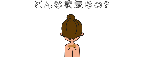 摩擦黒皮症とは？
