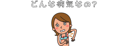 皮膚カンジダ症とは？