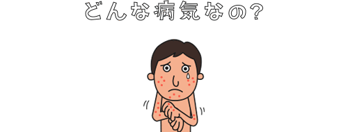 アトピー性皮膚炎とは？