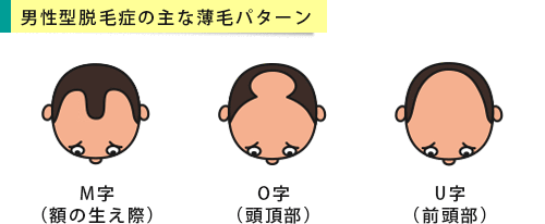 男性型脱毛症(AGA)の進行パターン