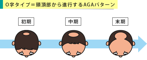頭頂部から薄毛が進行するO字ハゲの段階別イメージ
