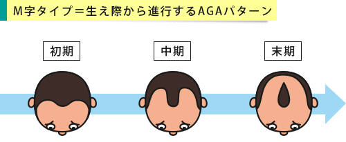 生え際から薄毛が進行するM字ハゲの段階別イメージ