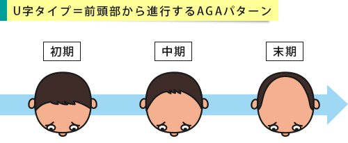 前頭部から頭頂部まで薄毛が進行するU字ハゲの段階別イメージ